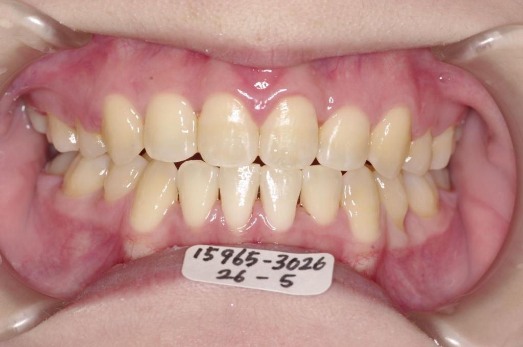 前歯、出っ歯・開咬の矯正治療後口内写真NO.1110