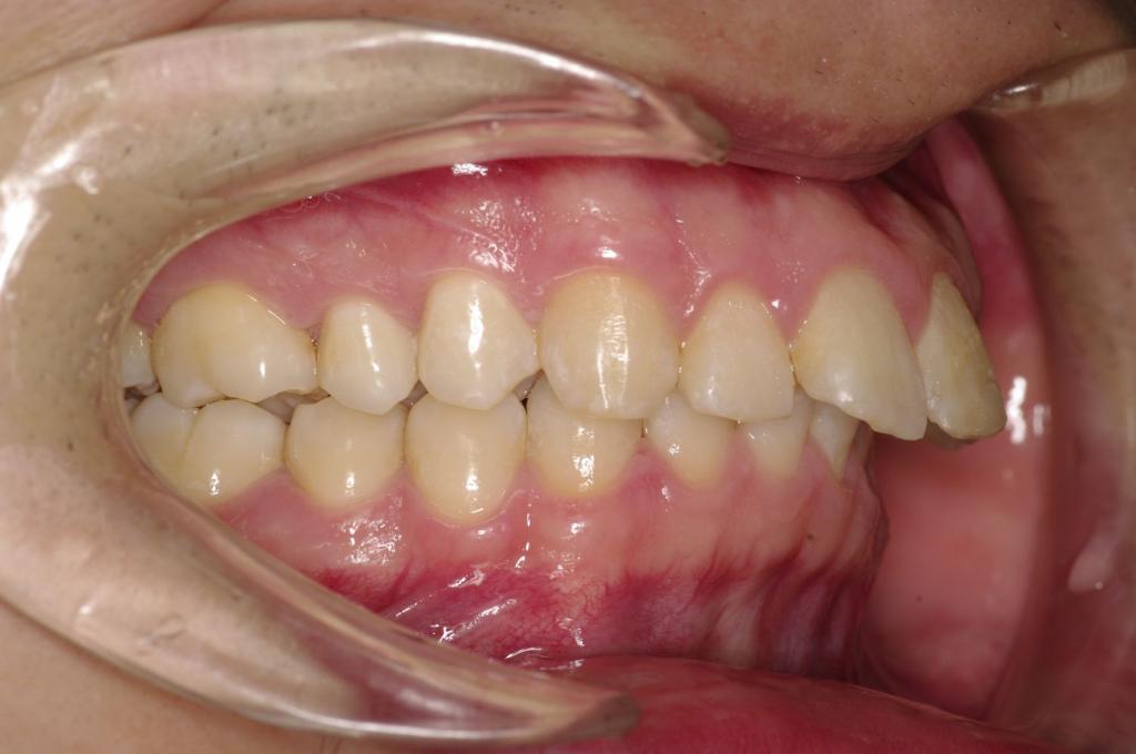 前歯、出っ歯・開咬の矯正治療前口内写真NO.1111