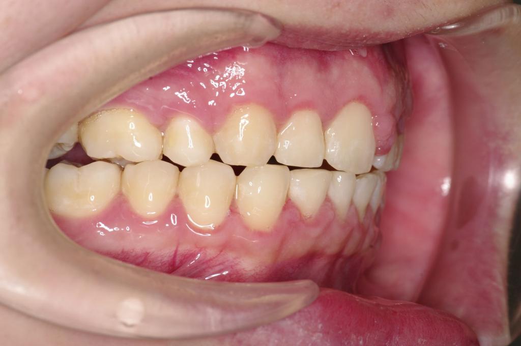 前歯、出っ歯・開咬の矯正治療後口内写真NO.1111