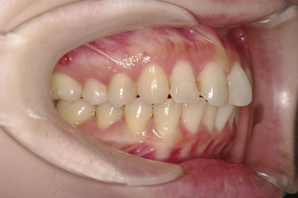 前歯、出っ歯・開咬の矯正治療前口内写真NO.1112