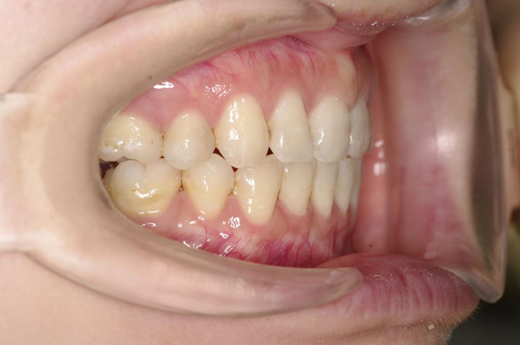 前歯、出っ歯・開咬の矯正治療後口内写真NO.1112