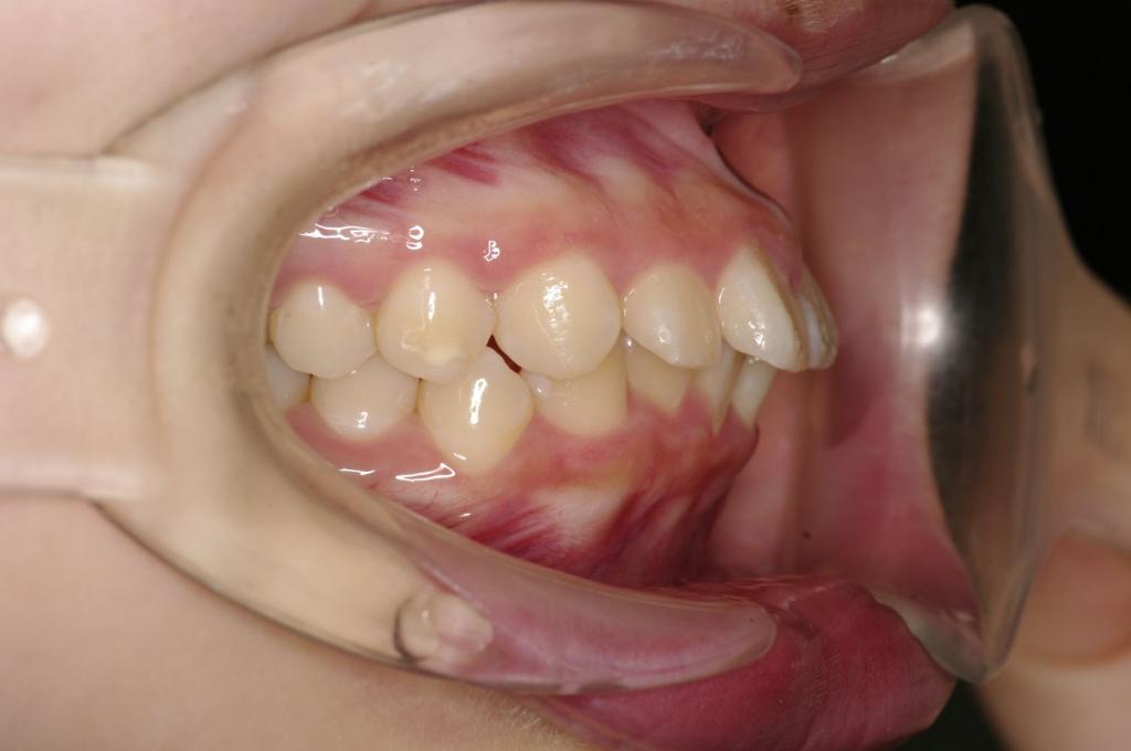 前歯、出っ歯・開咬の矯正治療前口内写真NO.1113