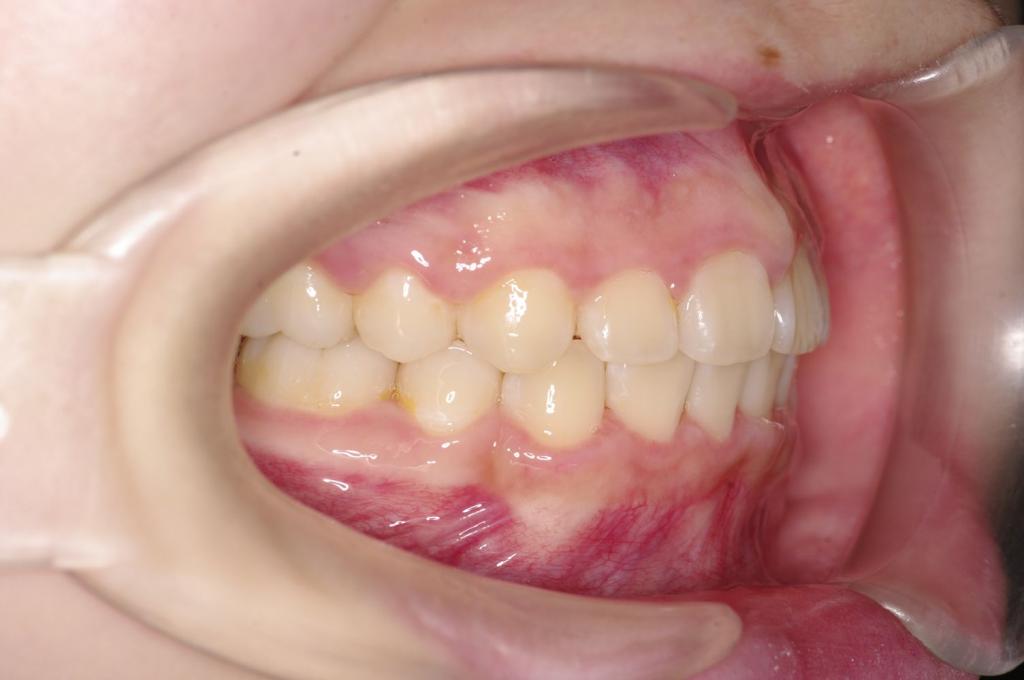 前歯、出っ歯・開咬の矯正治療後口内写真NO.1113