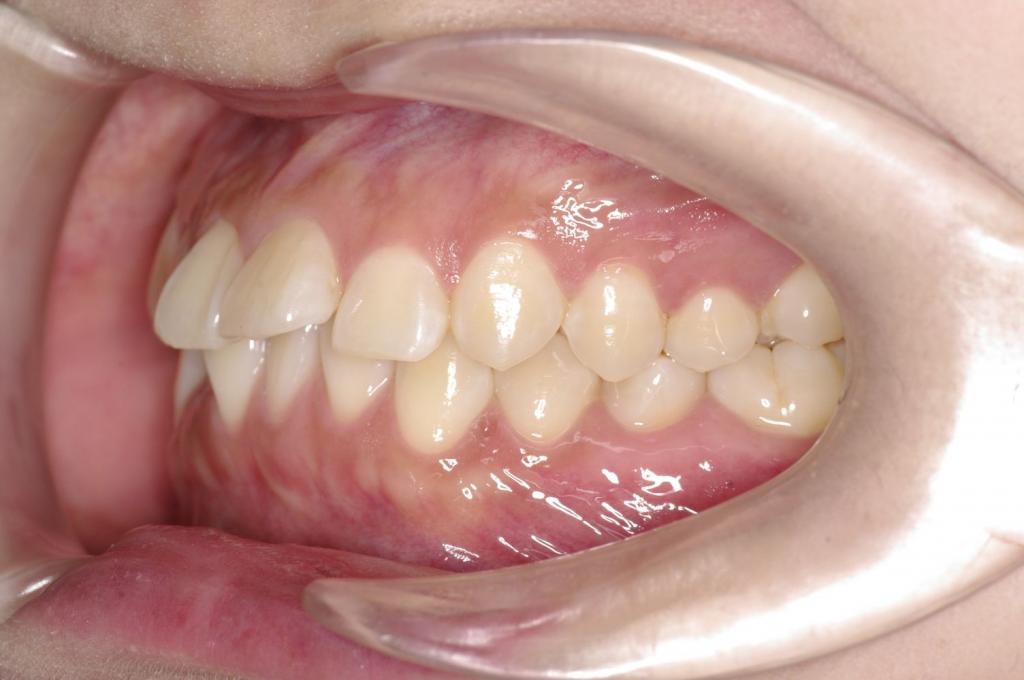 前歯、出っ歯・開咬の矯正治療前口内写真NO.1114