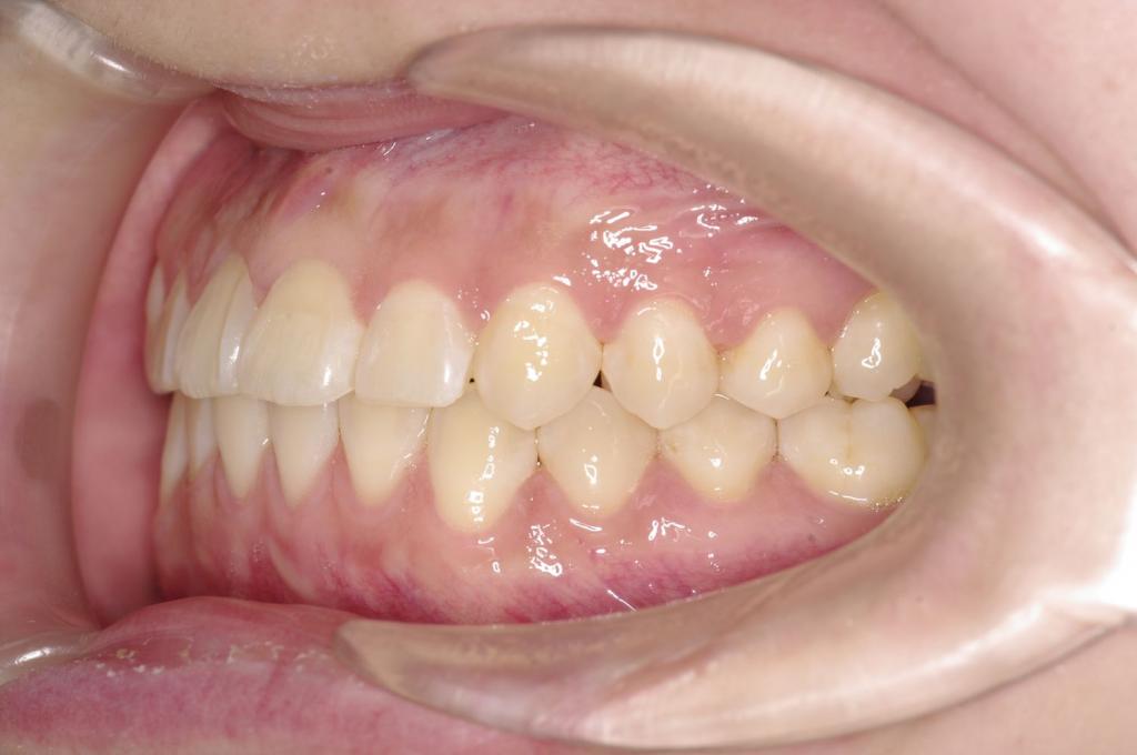 前歯、出っ歯・開咬の矯正治療後口内写真NO.1114