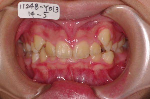 前歯、出っ歯・開咬の矯正治療前口内写真NO.495