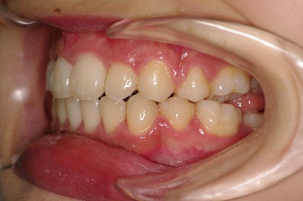 前歯、出っ歯・開咬の矯正治療後口内写真NO.513
