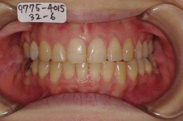 前歯、出っ歯・開咬の矯正治療後口内写真NO.516