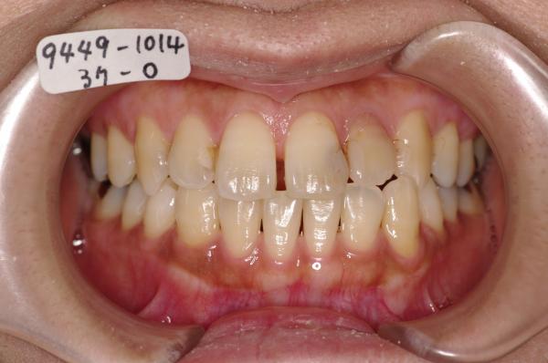 前歯、出っ歯・開咬の矯正治療前口内写真NO.523