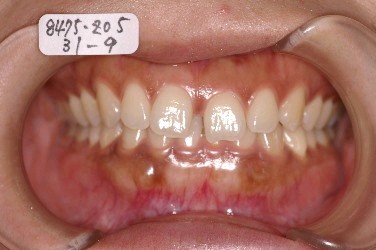 前歯、出っ歯・開咬の矯正治療前口内写真NO.54