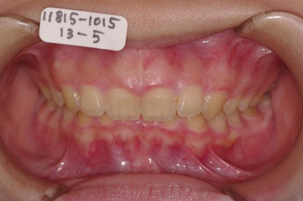 前歯、出っ歯・開咬の矯正治療前口内写真NO.556