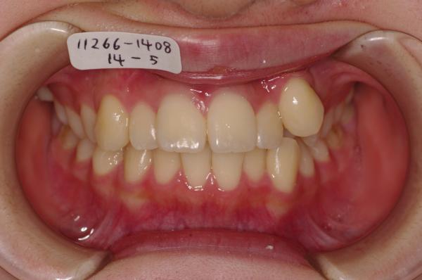 前歯、出っ歯・開咬の矯正治療前口内写真NO.578