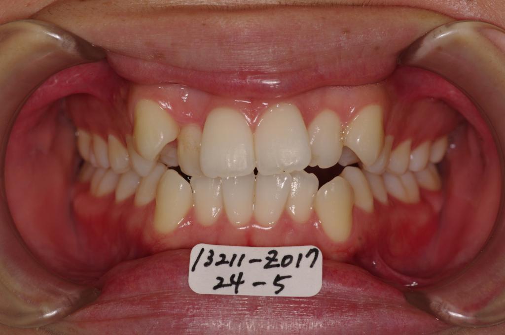 前歯、出っ歯・開咬の矯正治療前口内写真NO.791