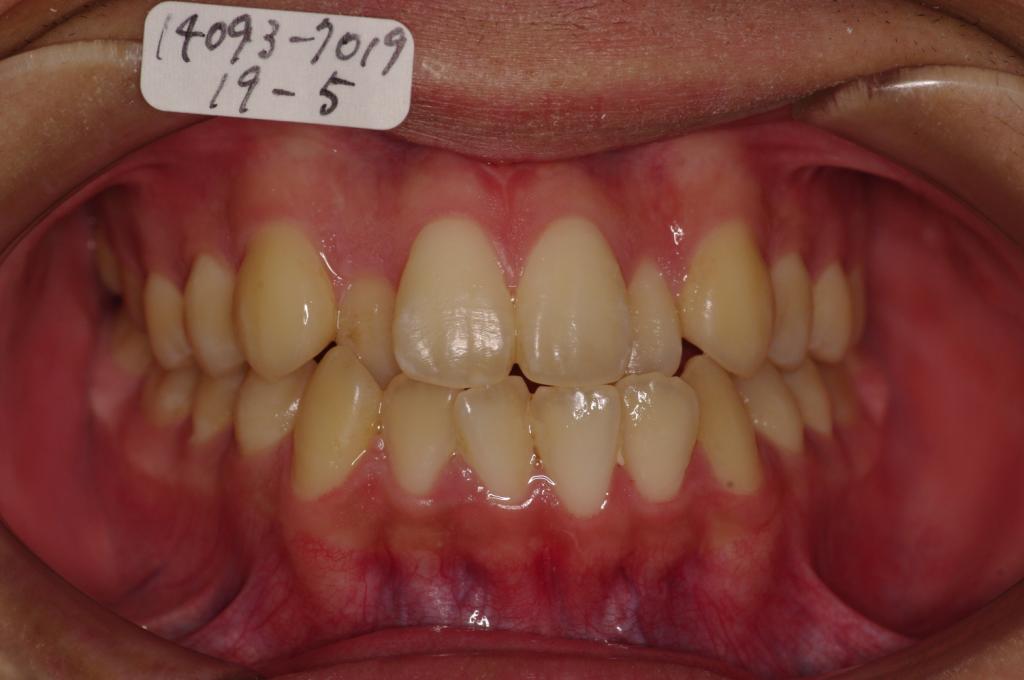 前歯、出っ歯・開咬の矯正治療前口内写真NO.935