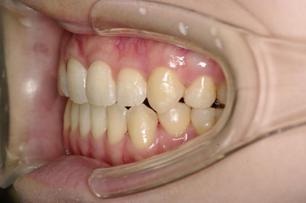 前歯、出っ歯・開咬の矯正治療後口内写真NO.985