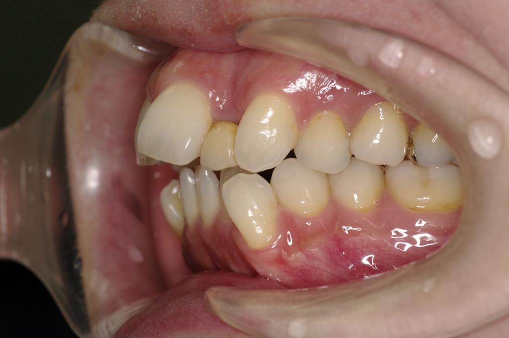 前歯、出っ歯・開咬の矯正治療前口内写真NO.986