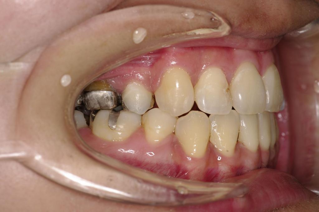 前歯、出っ歯・開咬の矯正治療前口内写真NO.987