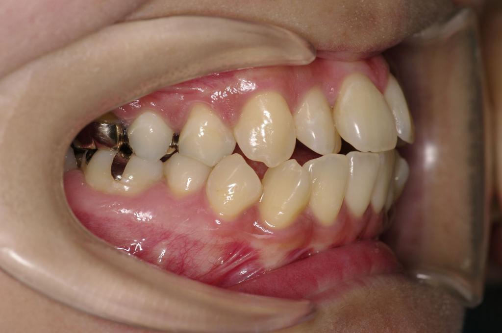 前歯、出っ歯・開咬の矯正治療後口内写真NO.987