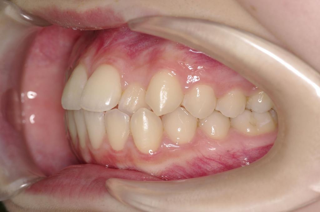 前歯、出っ歯・開咬の矯正治療前口内写真NO.988