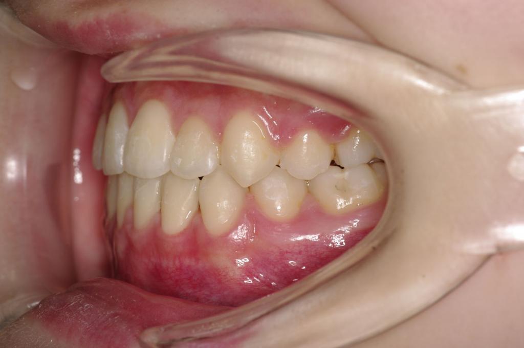 前歯、出っ歯・開咬の矯正治療後口内写真NO.988