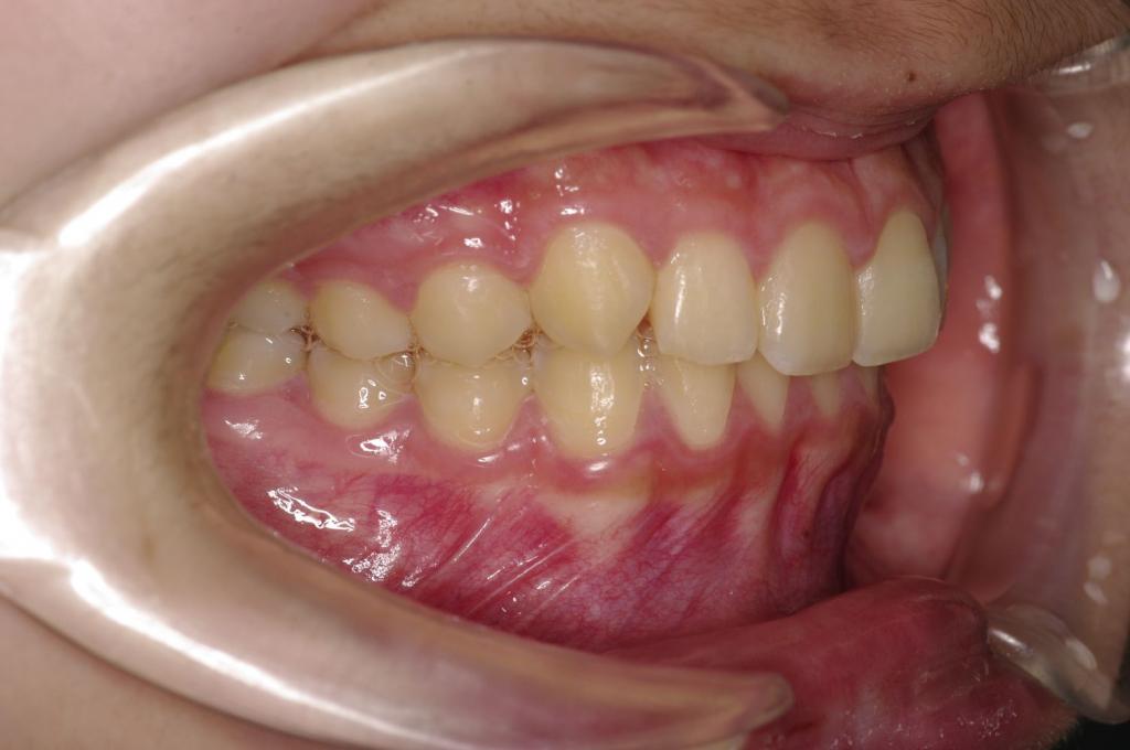 前歯、出っ歯・開咬の矯正治療前口内写真NO.990