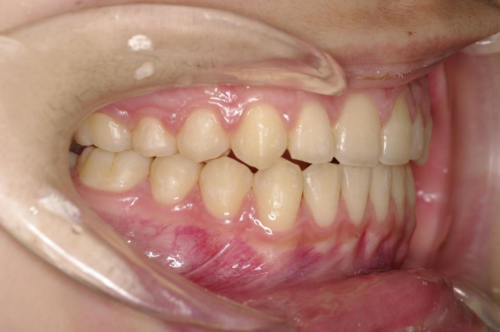 前歯、出っ歯・開咬の矯正治療後口内写真NO.990