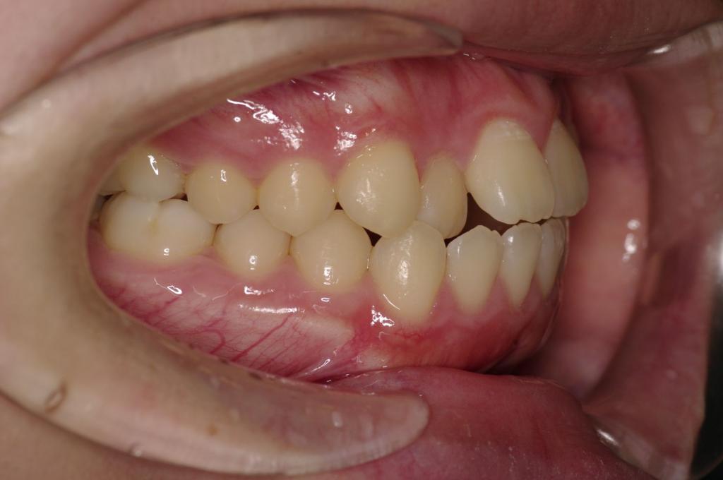 前歯、出っ歯・開咬の矯正治療前口内写真NO.991