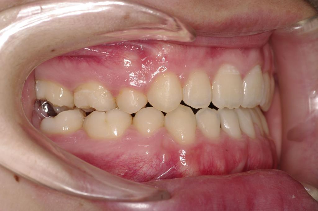 前歯、出っ歯・開咬の矯正治療後口内写真NO.991