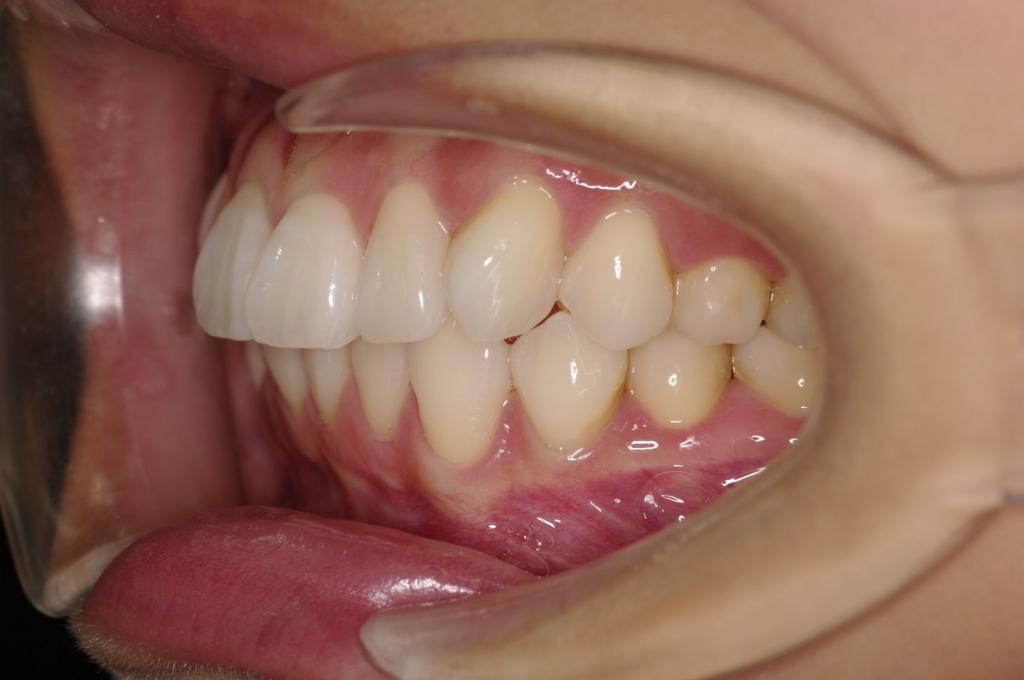 前歯、出っ歯・開咬の矯正治療前口内写真NO.992