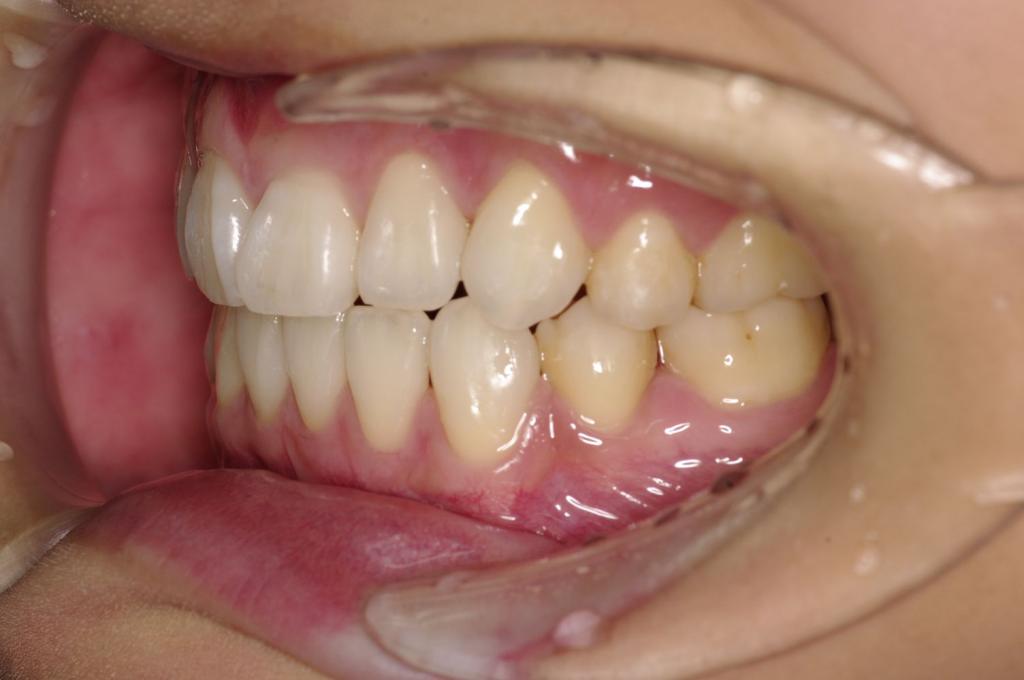 前歯、出っ歯・開咬の矯正治療後口内写真NO.992