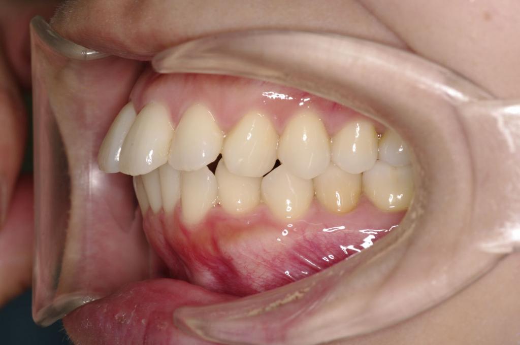 前歯、出っ歯・開咬の矯正治療前口内写真NO.993