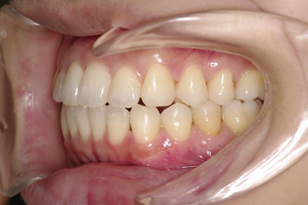 前歯、出っ歯・開咬の矯正治療後口内写真NO.993