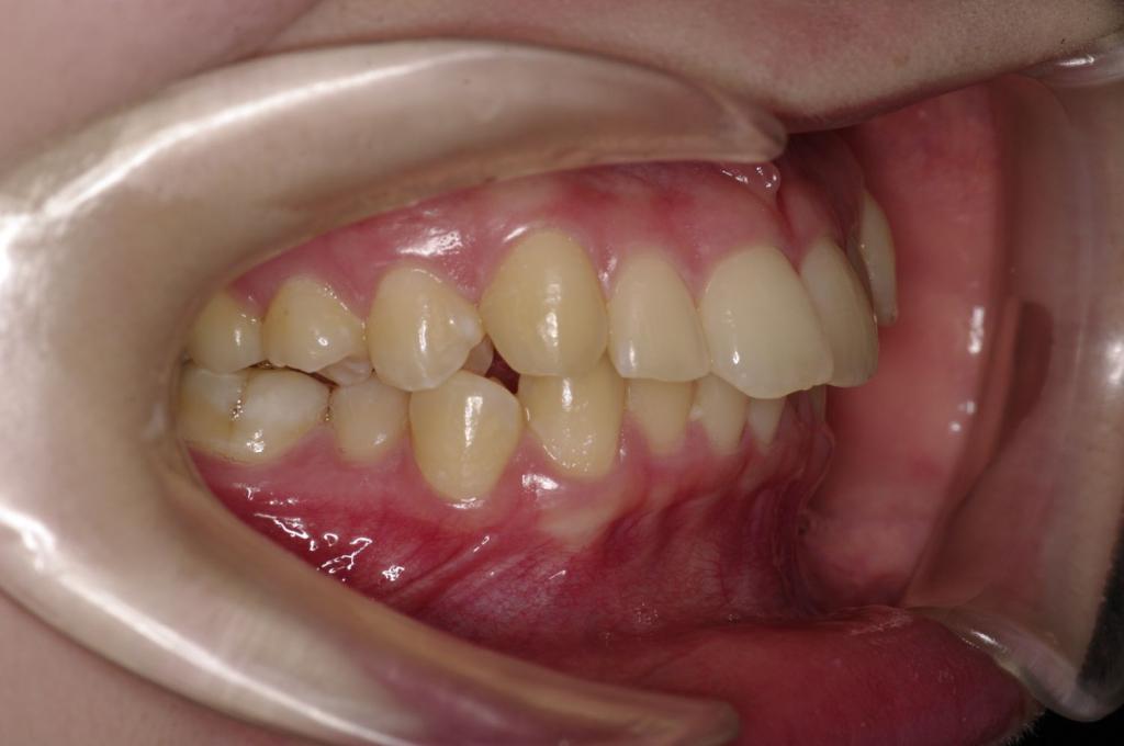 前歯、出っ歯・開咬の矯正治療前口内写真NO.994