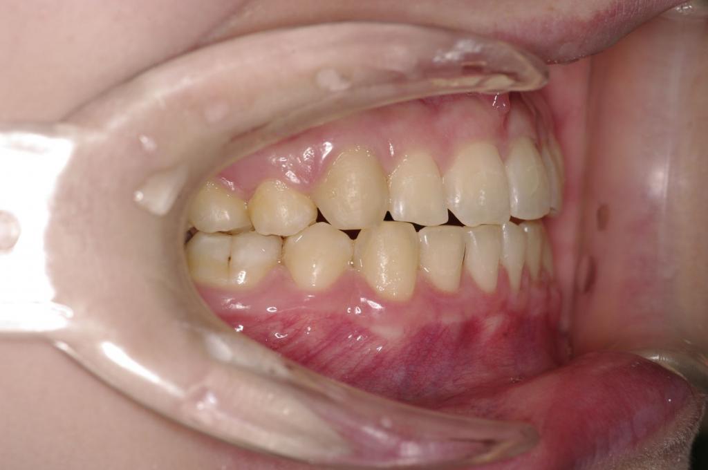 前歯、出っ歯・開咬の矯正治療後口内写真NO.994