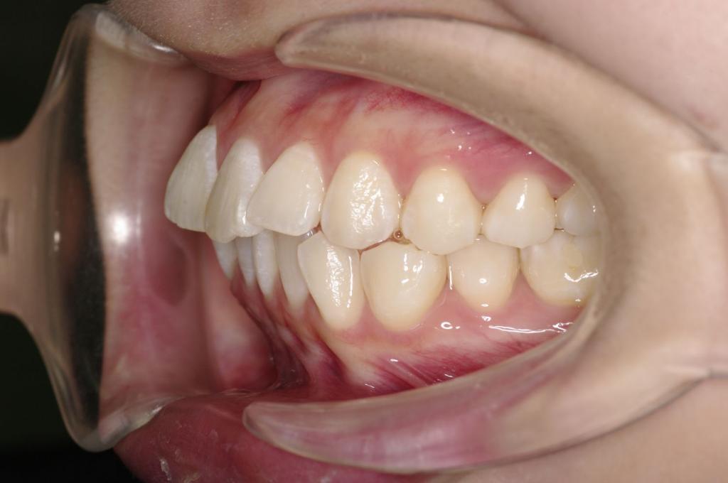 前歯、出っ歯・開咬の矯正治療前口内写真NO.995