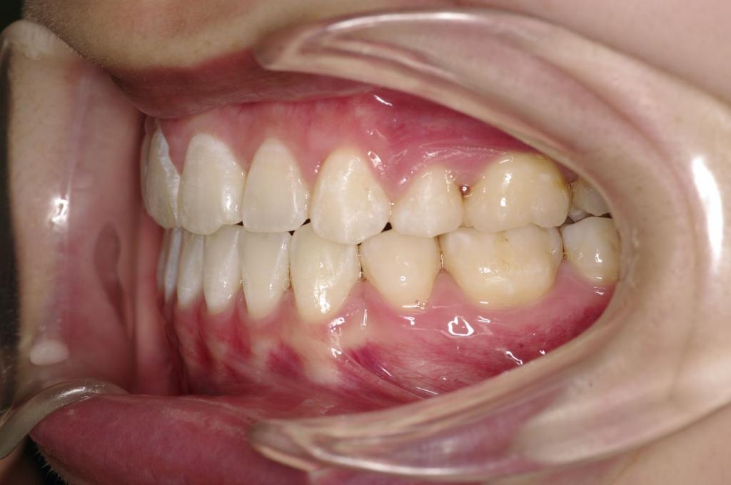 前歯、出っ歯・開咬の矯正治療後口内写真NO.995