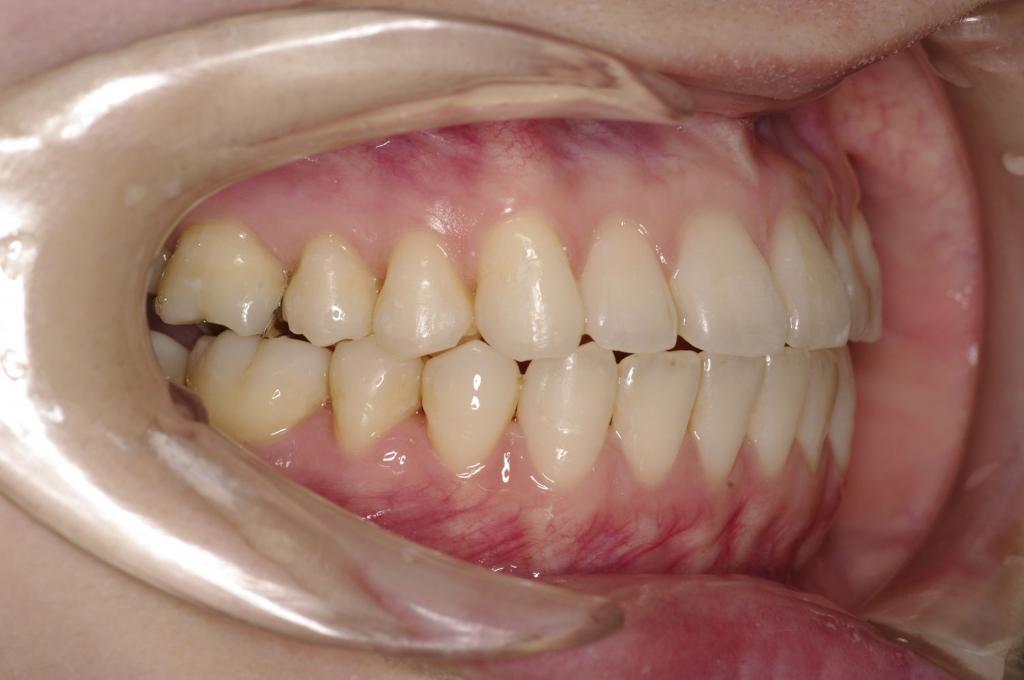 前歯、出っ歯・開咬の矯正治療後口内写真NO.996