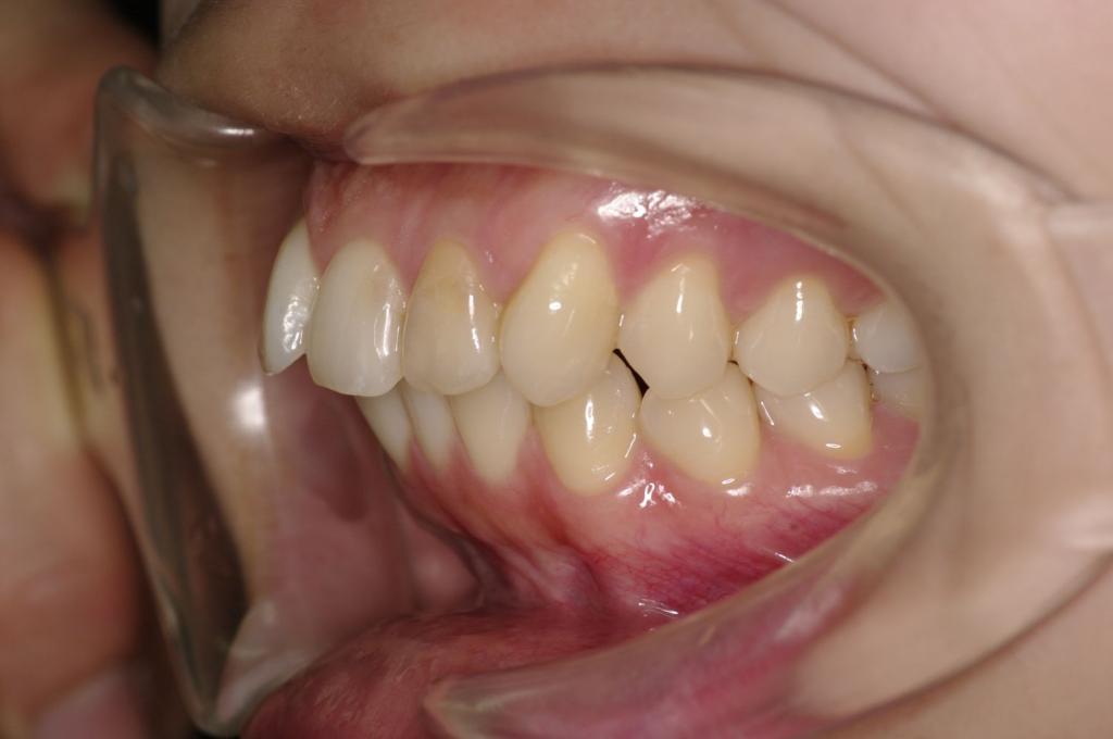 前歯、出っ歯・開咬の矯正治療前口内写真NO.997