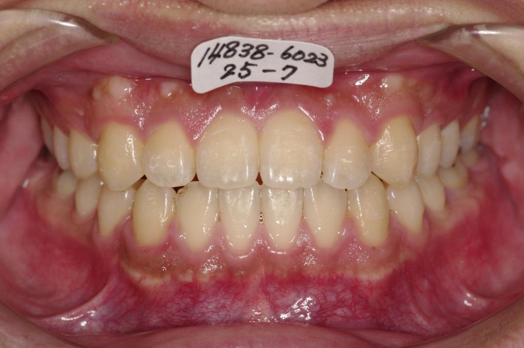 前歯、出っ歯・開咬の矯正治療後口内写真NO.998