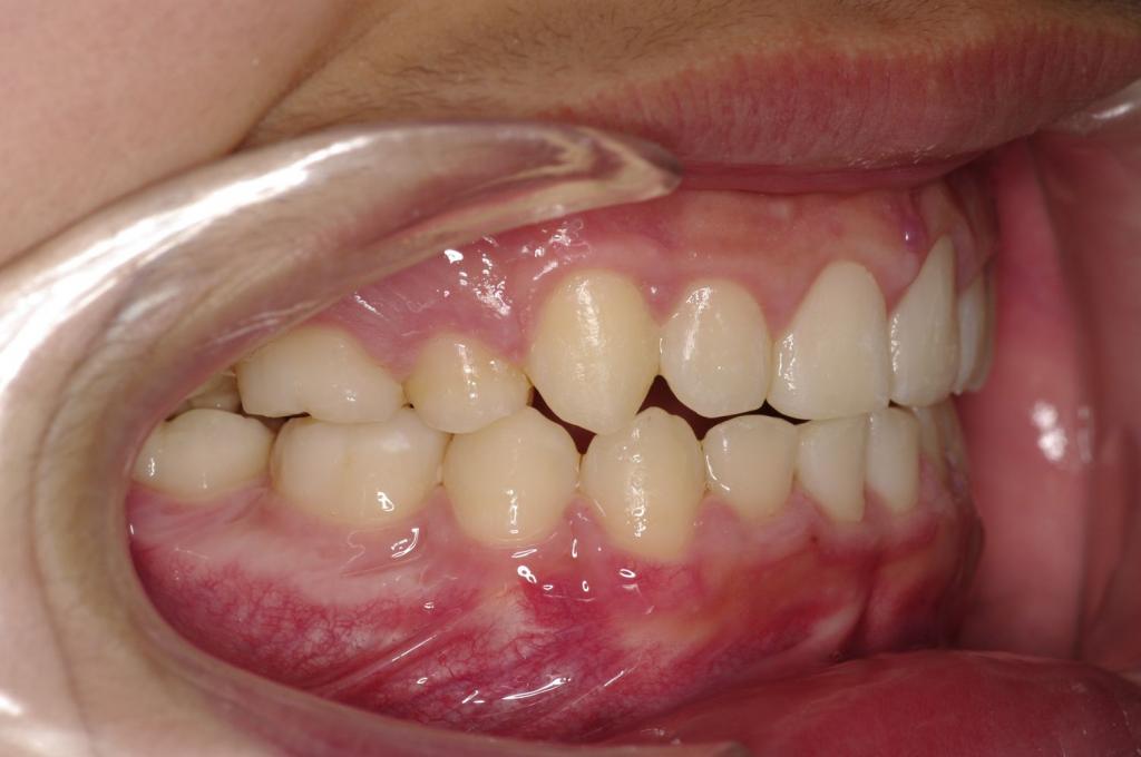 前歯、出っ歯・開咬の矯正治療前口内写真NO.999