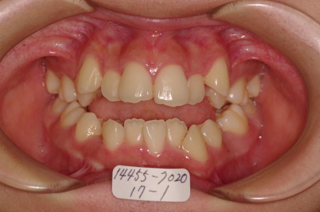 顎、顔の歪みの矯正治療前口内写真NO.302