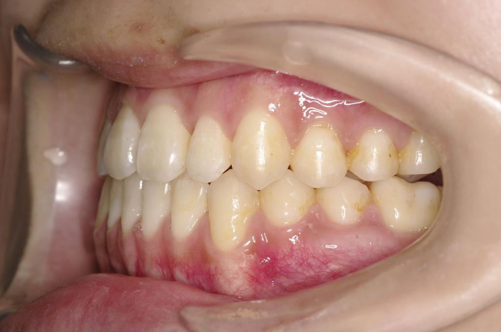 顎、顔の歪みの矯正治療後口内写真NO.339