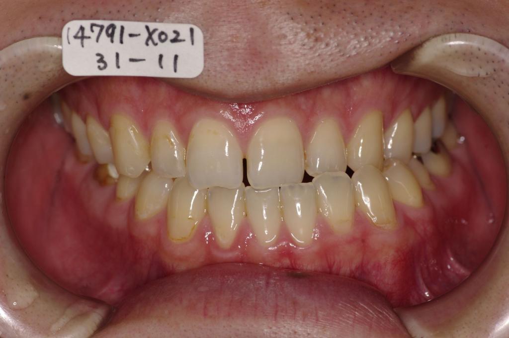 顎、顔の歪みの矯正治療前口内写真NO.340