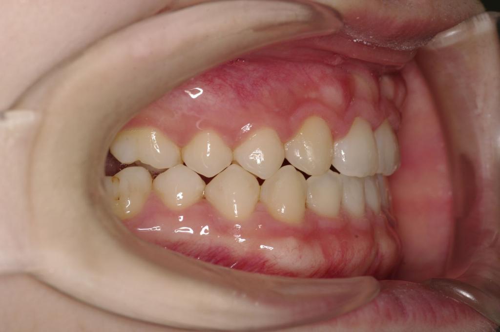 顎、顔の歪みの矯正治療後口内写真NO.342