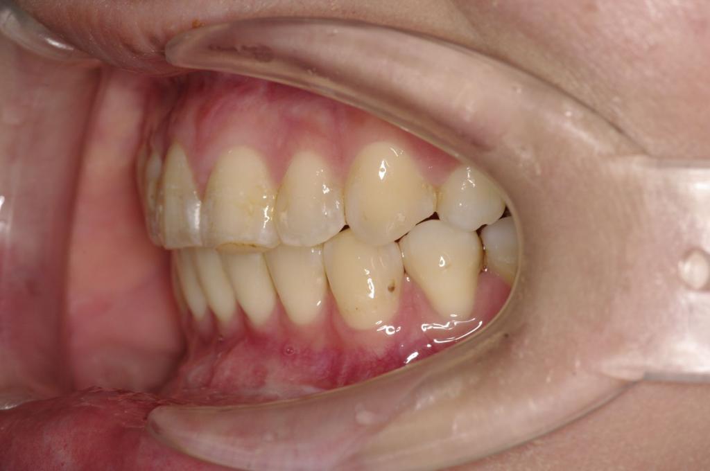 顎、顔の歪みの矯正治療後口内写真NO.345