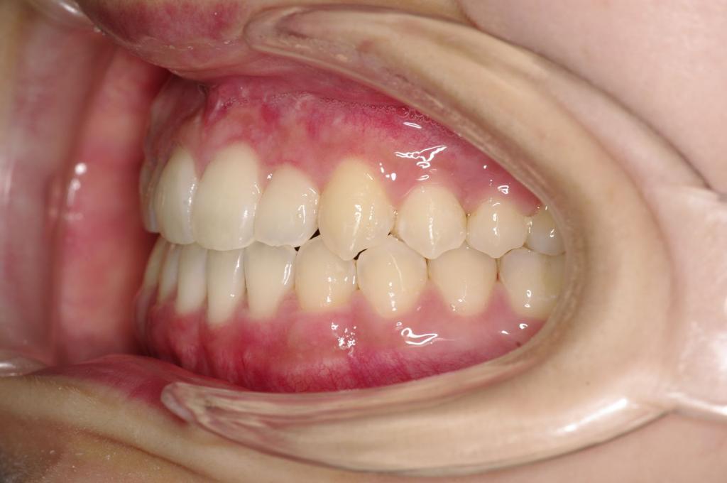 顎、顔の歪みの矯正治療後口内写真NO.369