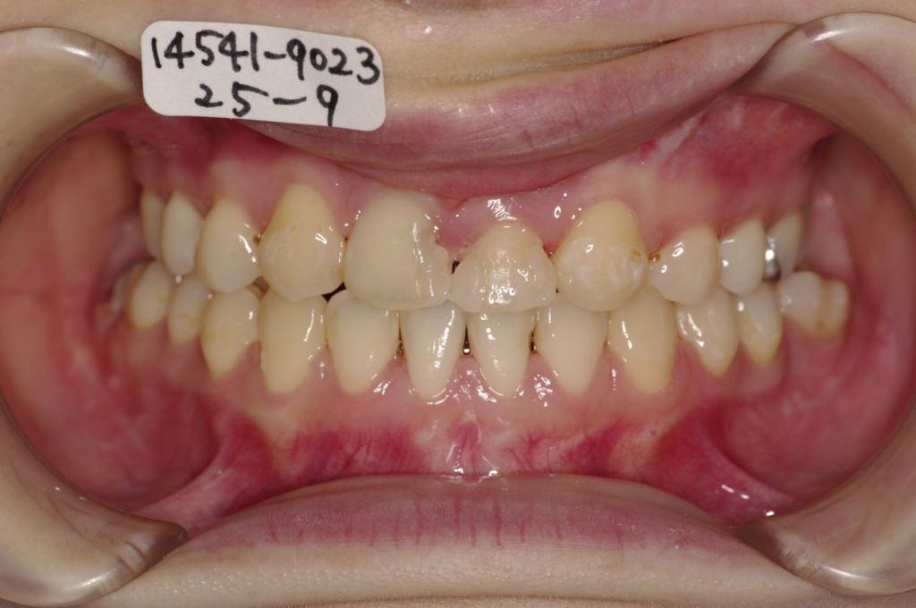 顎、顔の歪みの矯正治療後口内写真NO.377