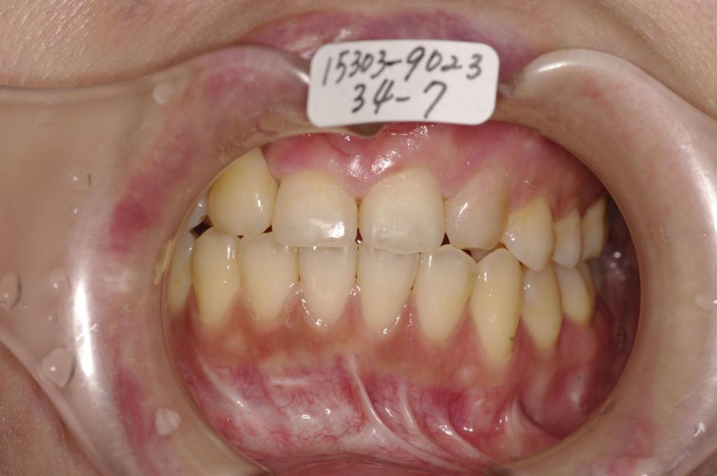 顎、顔の歪みの矯正治療後口内写真NO.378