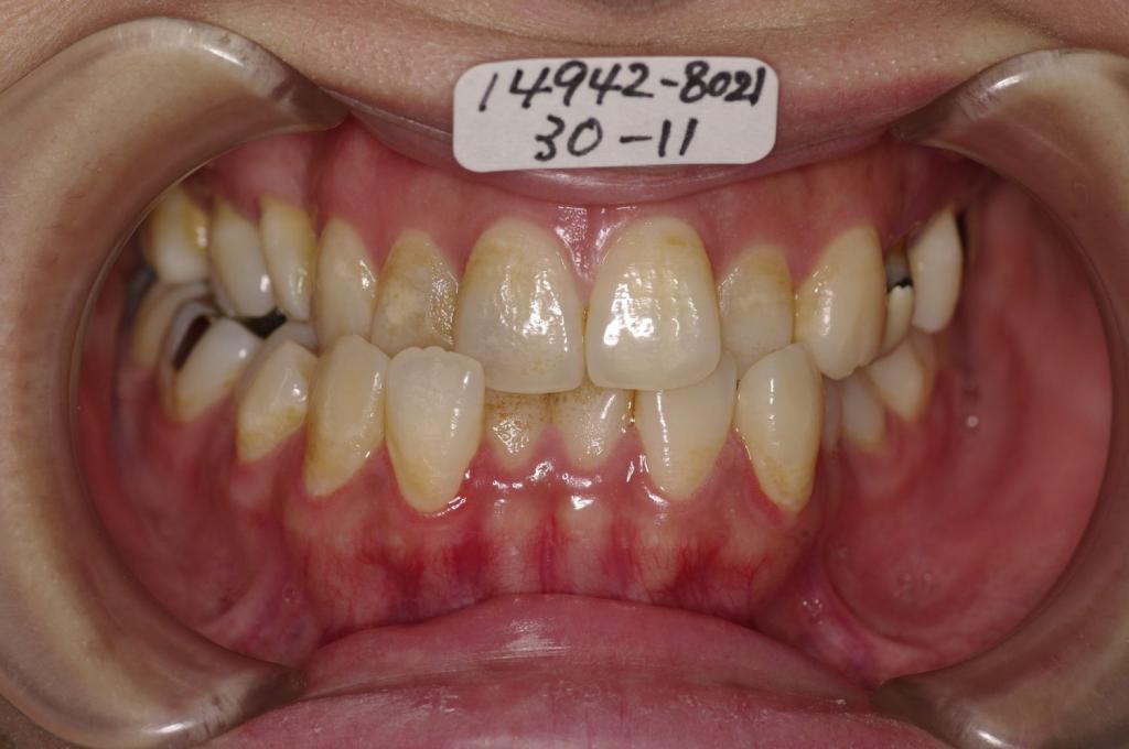 顎、顔の歪みの矯正治療前口内写真NO.379