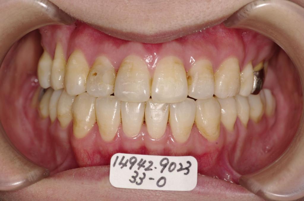 顎、顔の歪みの矯正治療後口内写真NO.379
